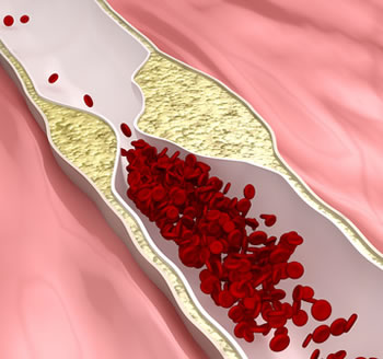 Peripheral Artery Disease.