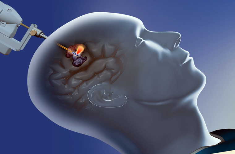Brainwave: Monteris's NeuroBlate System offers comprehensive laser ablation.