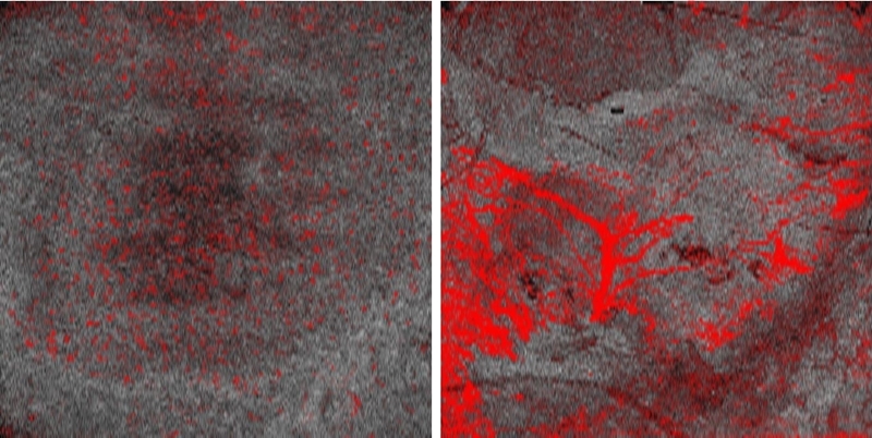 Staging melanoma by blood-vessel development