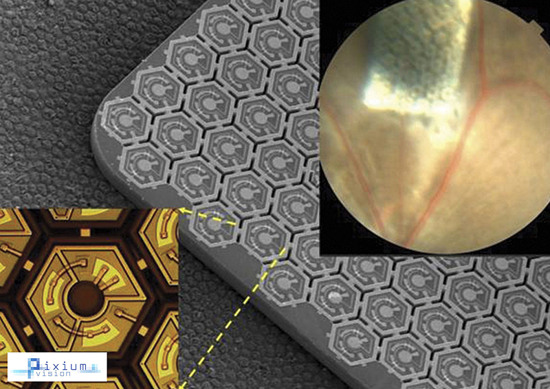 Sub-retinal miniaturized wireless photovoltaic implant.