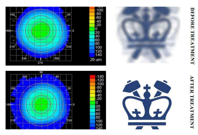 Eyes right: Corneal topography before and after the treatment.