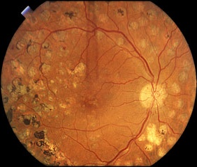 Laser-treated retina