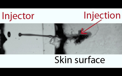 How the laser pulse-driven injectant passes through the skin into a patient’s tissue.