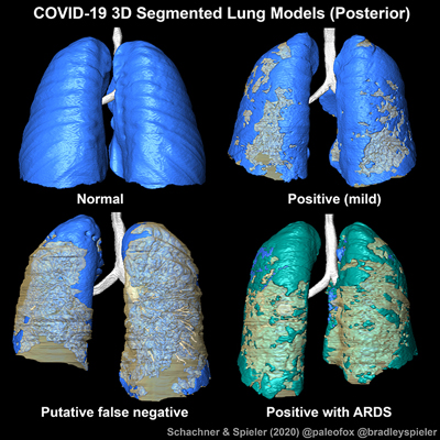New Orleans team improves imaging diagnosis of Covid-19. Click for info.
