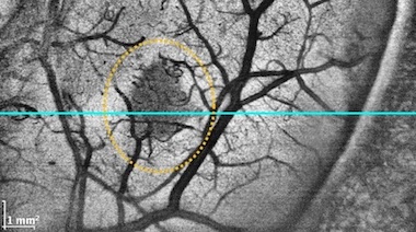 High frequency: clear view of tumors