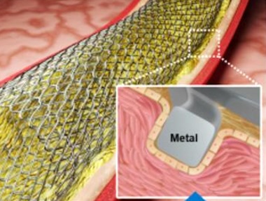 Test pattern: stent surfaces