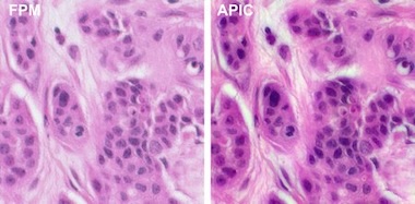 Cancer cells: FPM vs APIC