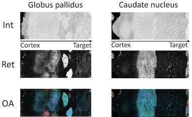 Position critical: DBS treatment