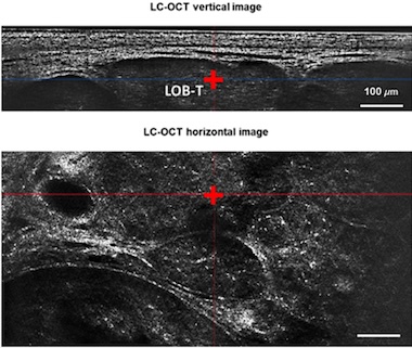 Cellular resolution: cancer tissues