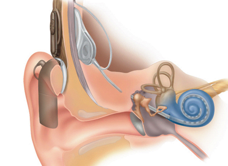 Hear hear: LZH's improved cochlear implant showcased at Hanover Fair.