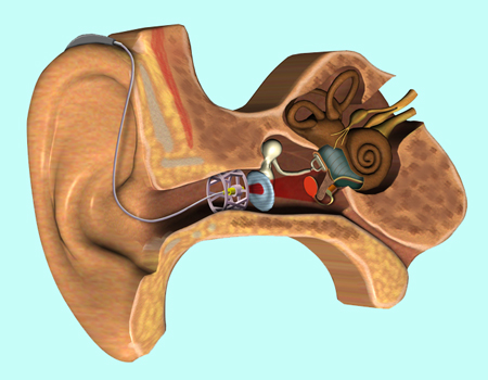 The aid has three parts: microphone; optical transmitter to middle ear; and electro-acoustic transducer.