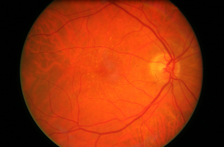 Treatment in sight? In the US, there are more than 10 million already living with AMD.