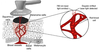 Laser Doppler probe is placed over a skin malignant melanoma. 