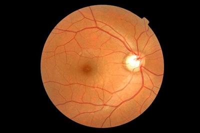Retinal imaging